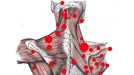 Σημεία ενεργοποίησης στους μύες που προκαλούν μυοαγγειακό πόνο στην πλάτη