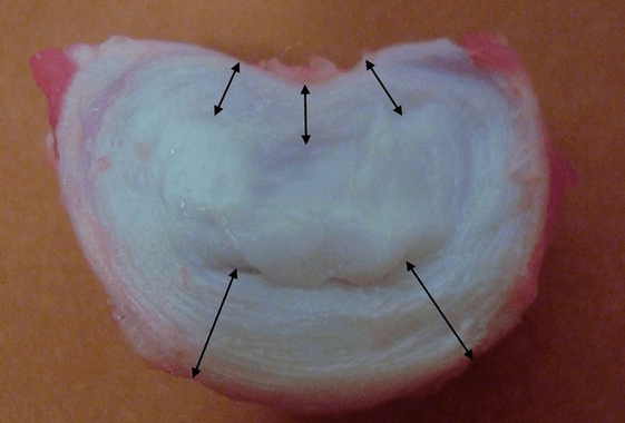 πώς μοιάζει ένας μεσοσπονδύλιος δίσκος